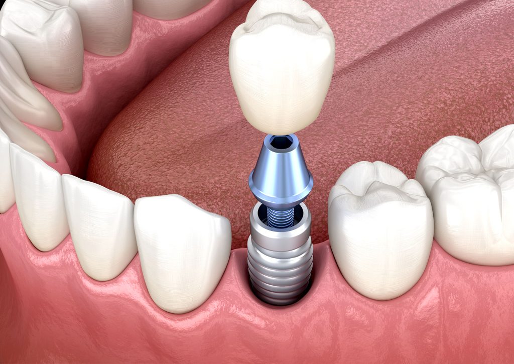 広島市　佐伯区　楽々園　インプラント