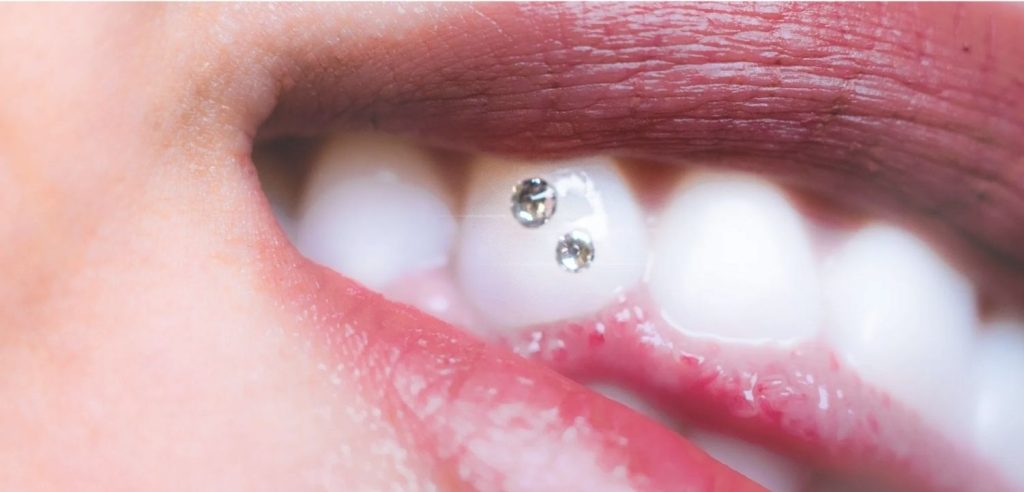 広島市歯医者　佐伯区歯医者　楽々園歯医者　海老園歯医者　えみたす歯科・矯正歯科　イオンタウン楽々園院　ティースジュエリー