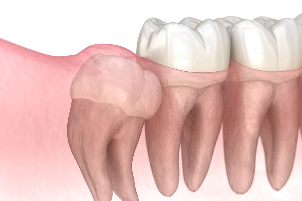 広島市歯医者　佐伯区歯医者　楽々園歯医者　海老園歯医者　廿日市市歯医者　吉見園歯医者　旭園歯医者　歯周病　えみたす歯科・矯正歯科　歯髄炎