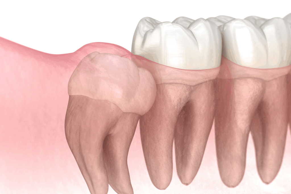 広島市歯医者　佐伯区歯医者　楽々園歯医者　海老園歯医者　廿日市市歯医者　えみたす歯科・矯正歯科　イオンタウン楽々園院　広島市でおすすめの歯医者　広島親知らず抜歯歯医者　横向き親知らず　親知らず　佐伯区親知らず