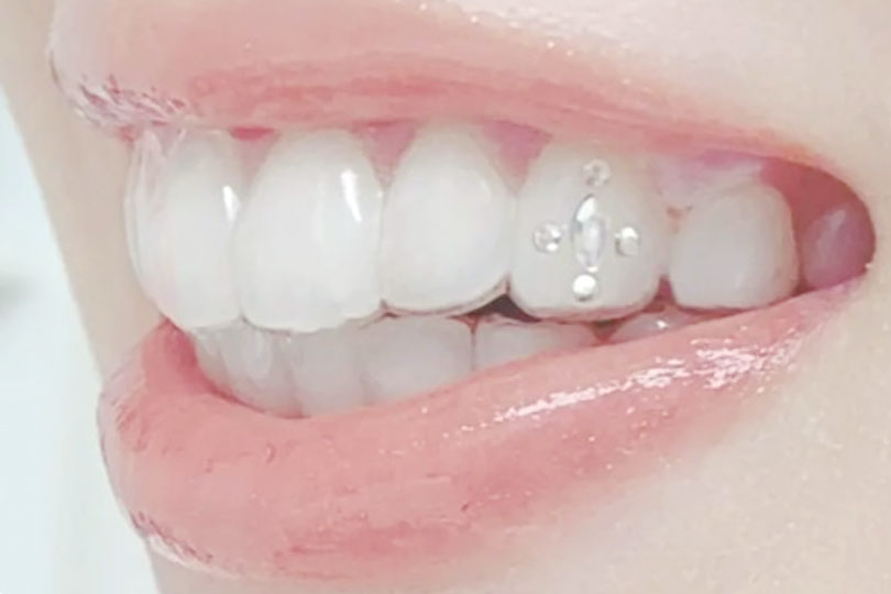 広島市歯医者　佐伯区歯医者　楽々園歯医者　海老園歯医者　廿日市市歯医者　えみたす歯科・矯正歯科　イオンタウン楽々園院　広島市でおすすめの歯医者　マウスピース矯正　マウスピース　マウスピースジュエリー　インビザライン