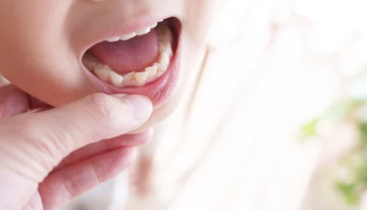 歯科 歯医者 広島市歯医者 佐伯区歯医者 楽々園歯医者 海老園歯医者 廿日市市歯医者 えみたす歯科・矯正歯科 イオンタウン楽々園院 広島市でおすすめの歯医者 歯科 歯医者 親知らずの抜歯 親知らずが原因で歯並びが悪くなるの?